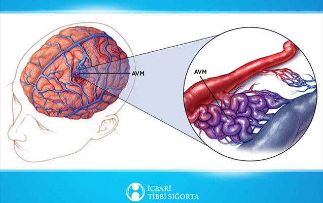 Bu əməliyyat da icbari tibbi sığorta ilə icra olunur